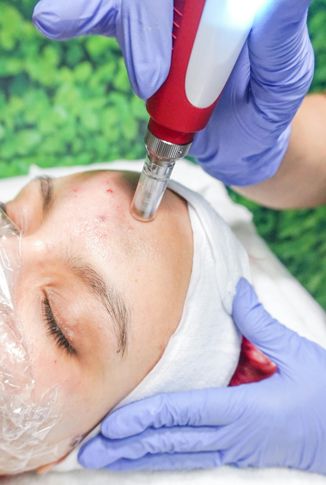 Microneedling